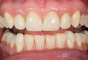 The image shows a close-up view of a person s teeth with an emphasis on yellowing and staining, possibly indicating poor oral hygiene or dental issues.