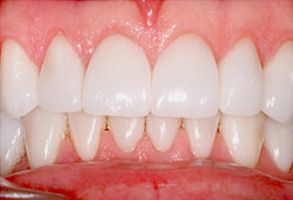 The image shows a close-up of a person s teeth with visible staining or discoloration.