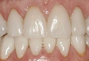 The image shows a close-up view of a person s teeth with a focus on a smile, revealing white teeth and a partial view of the gums.