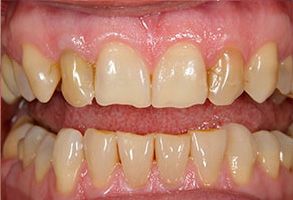 The image shows a close-up view of a person s teeth with a focus on a dental procedure involving tooth alignment, possibly during orthodontic treatment.